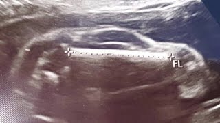 Sonogram shows WHAT [upl. by Charters606]