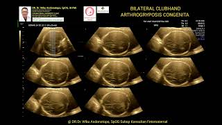 Arthrogryposis congenita 23 weeks [upl. by Ynttirb]