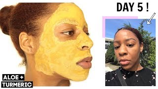 I Used an Aloe Vera amp Turmeric Face Mask For 5 DAYS amp THIS HAPPENED [upl. by Adnirim]