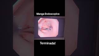 Manga Endoscopica por el Dr Don Portocarrero Top Doctors Los Angeles CA [upl. by Storfer758]