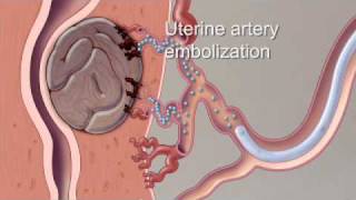 Fibroid Treatment Options  Mayo Clinic [upl. by Eimar]