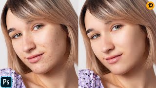 How To Remove Skin Blemishes In Photoshop 2024 [upl. by Oratnek]