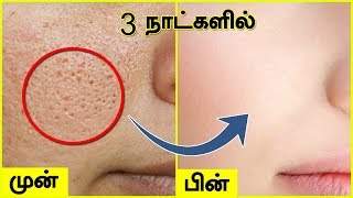 முகத்தில் உள்ள சிறுசிறு குழிகள் OPEN PORES மறைய  Open Large Pores on Face [upl. by Carnahan825]