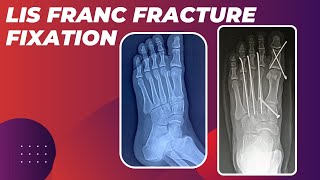 LISFRANC FRACTURE FIXATION IN A YOUNG MALE ASSOCIATED WITH MULTIPLE METATARSAL FRACTURES [upl. by Maurene]