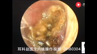 One case of cholesteatoma of external auditory canal was cleared in 15 minutes [upl. by Maidel]