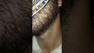 Carly hair increasing Carly hair problem beard hairstyle 181viralshortsatisfying [upl. by Hartman]