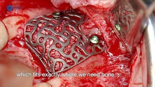 Customized Bone Regeneration CBR with Titanium Mesh LiveOP 2017 [upl. by Rissa313]