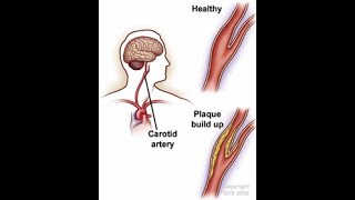 Carotid Bruits  Definition Types Causes Clinical Significance Carotid Artery stenosis [upl. by Eiwoh]