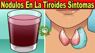 Nódulos En La Tiroides Síntomas y Tratamiento Natural Prueba Este Jugo y Bébelo De Esta Forma [upl. by Edas]