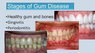 Stages of gum disease final edit 3 [upl. by Akimyt]