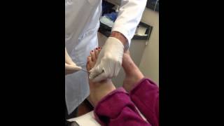 5th Metatarsal Pin Removal [upl. by Harriet781]