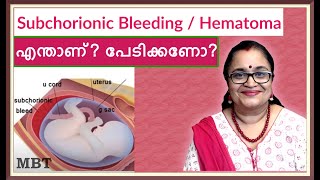 Subchorionic HematomaBleeding In Pregnancy What Is It Should You Be Afraidഎന്താണ്പേടിക്കണോMBT [upl. by Buiron]