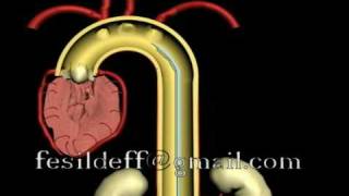 IABP Intraaortic Ballon Pump [upl. by Alfonso619]