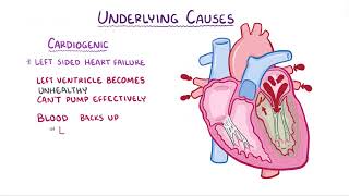 Pulmonary Edema causes symptoms diagnosis treatment pathology [upl. by Anerb553]