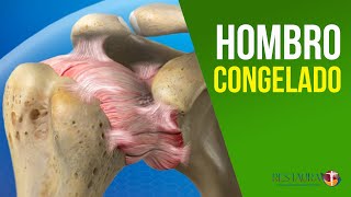 Hombro congelado  Capsulitis adhesiva del hombro  Causas y tratamiento [upl. by Ahsinrats]