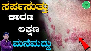 ಸರ್ಪಸುತ್ತು ಸಮಸ್ಯೆಗೆಮನೆ ಮದ್ದು  Sarpa Suttu in Kannada  Sarpa Suttu Symptoms in Kannada [upl. by Eleinad745]