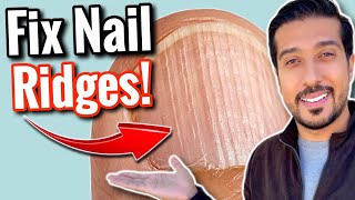 Vertical Ridges on Nails  What Are Your NAILS Trying to Say [upl. by Heriberto22]