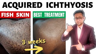 Acquired ichthyosis  Fish skin  Treatment  Hindi [upl. by Aziar64]