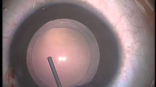 Pediatric Cataract Surgery Lens Aspiration PCCC Anterior Vitrectomy and IOL Implanation [upl. by Worrad]