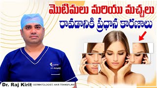 మొటిమలకు కారణాలు  Causes Of Pimples and Dark Spots  Nodular Cystic Acne  Celestee Skin Clinic [upl. by Irtemed]