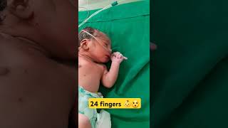 polydactyly finger in bilateral hands feet shorts shortsfeed cutebaby trending youtubeshortsyt [upl. by Verge]