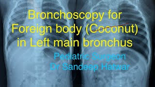 Left bronchial foreign body [upl. by Zerat509]