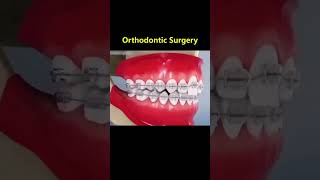 Ortho Treatment open bite العلاج التقويم للعظه المفتوحه 🎖️👌 [upl. by Eniamat]