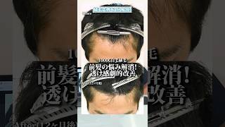 【植毛解説】前髪薄毛が気になる方必見！生え際植毛で変わる前髪透け感 植毛 [upl. by Rimaa]