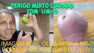 ESSA POMADA FAZ MILAGRES  VC ESTA COM MICOSE ALERGIAS E MANCHAS ESSA POMADA AJUDOU MUITAS PESSOAS [upl. by Ereveneug]