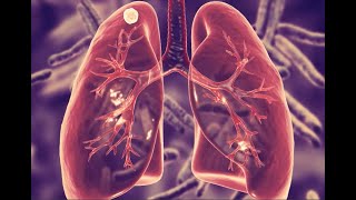 Everything you need to know about a LUNG NODULE in 6 minutes [upl. by Enomaj]