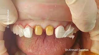 Emax Crown Cementation dentist dentistry dental cosmeticdentistry [upl. by Namijneb671]