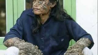 Dede Koswara  Tree Man of Java [upl. by Byers334]