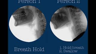 Swallowing postures and maneuvers with videofluoroscopy two healthy adults [upl. by Brod671]