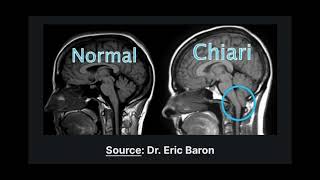 Sindrome di Budd Chiari e nevralgia occipitale [upl. by Nywra]