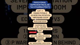 PAROXYSMAL SUPRAVENTRICULAR TACHYCARDIA PSVT [upl. by Henleigh]