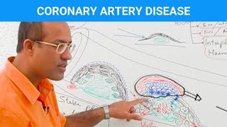 Coronary Artery Disease  Ischemic Heart Disease  Angina🫀 [upl. by Naloc]