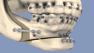 BSSO amp Osseous Genioplasty [upl. by Henig390]