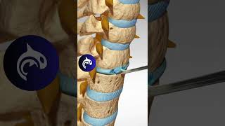 See how an Artificial Cervical Disc Replacement of the Spine works in 3D animation [upl. by Whitehurst919]