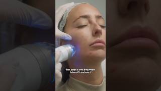 EndyJET The combo of RF Microneedling amp Agejet Plasma  Dr Medispa [upl. by Ahsinrats]