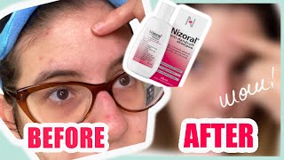 Nizoral Shampoo Against Fungal Acne  Is it Effective [upl. by Ellennej442]