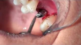 Cementation on implant crown [upl. by Kinemod379]