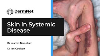 Skin in systemic disease a specialised overview [upl. by Azil]