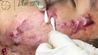 Treatment of acne pustules severe inflammation  Điều trị mụn mủ viêm nặng  LAMSPA PHUQUOC L P11 [upl. by Goldina]