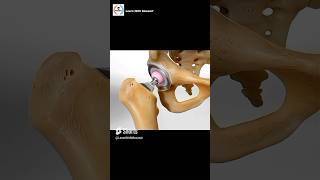 Total Hip Replacement Procedure  Animation [upl. by Hump804]