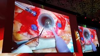 ASCRS 2018 Film Festival Best of the Best [upl. by Samid]