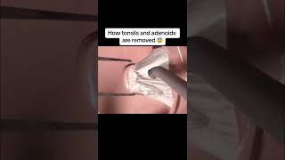 How Tonsils and adenoids are removed 💀 3danimation facts viral [upl. by Dupuis]