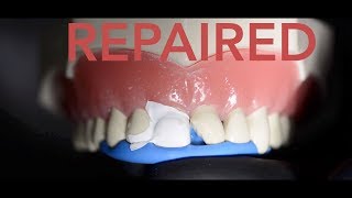 How the dentist repairs a chipped tooth [upl. by Aubarta84]