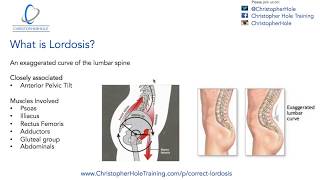 Lordosis Treatment A 3 Step Process [upl. by Fitzhugh]