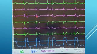 7 Pericardiocentesis  Confirming Location [upl. by Dressel]