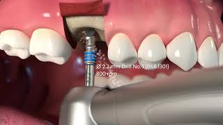 Protocole de pose de l’implant Straumann® TLX [upl. by Namzzaj]